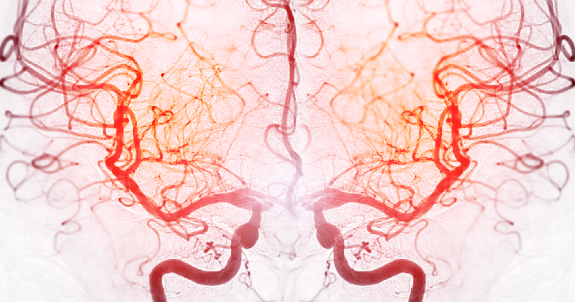 Colored angiogram of normal brain blood vessels.