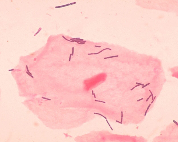 Rod-shaped members of the genus Lactobacillus surround squamous epithelial cells