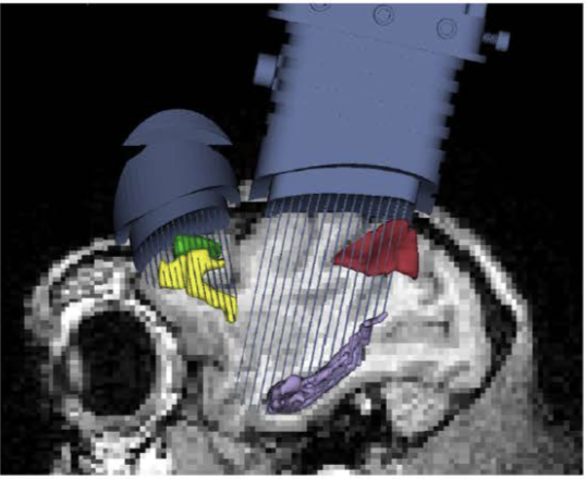 electrodes in brain