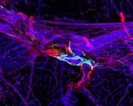 amyloid buildup