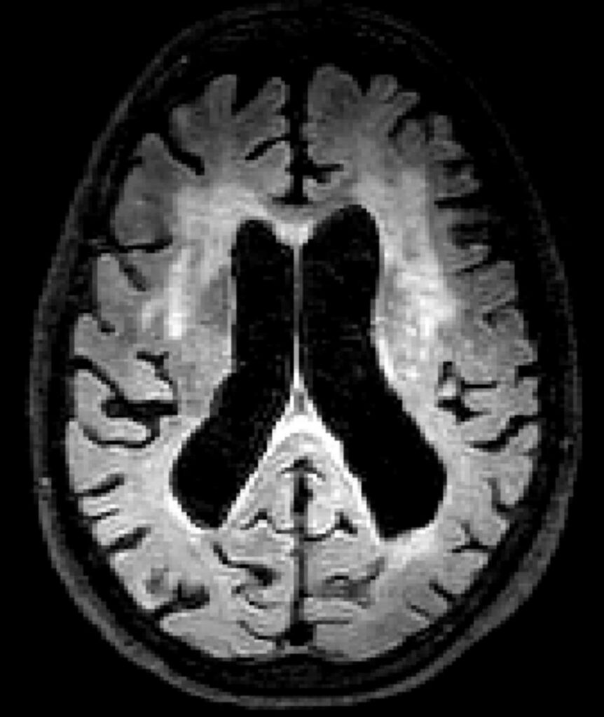 MRI scan showing vascular damage.