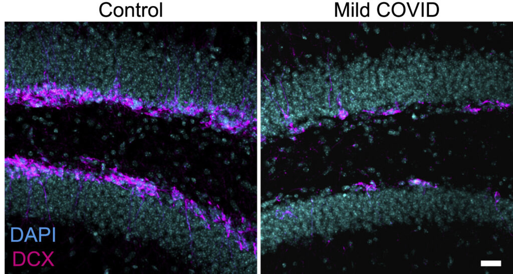 Side-by-side brain tissue images labeled Control and Mild COVID. Blue (DAPI) and magenta (DCX) staining highlight structural differences, with fewer magenta signals in the Mild COVID sample.