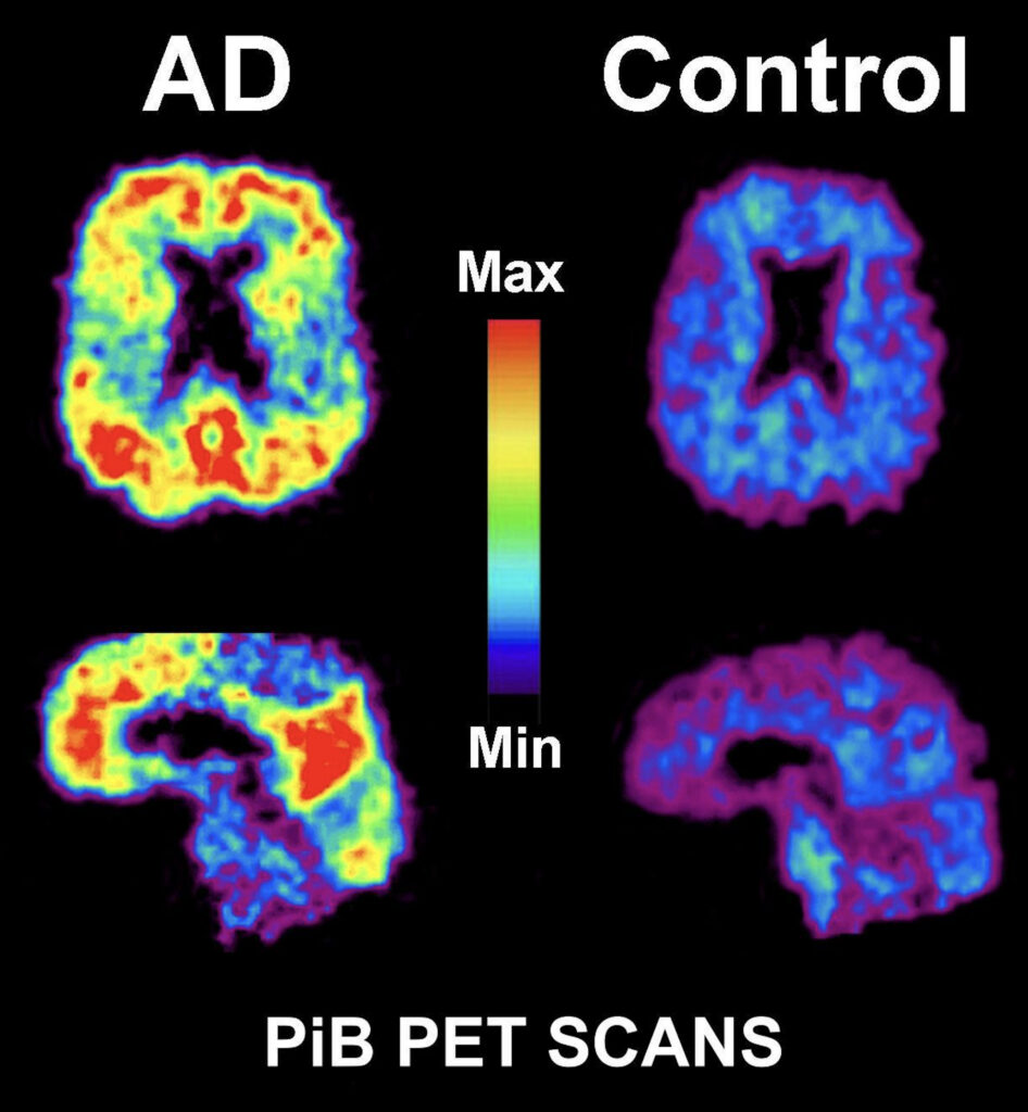 PIB PET Scan