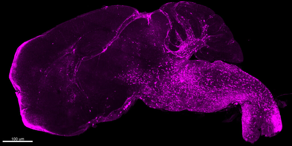 BRAF-V600E mutant microglia take over the hindbrain
