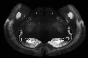 Black and white MRI scan of a brain cross-section, showing symmetrical structures and varying tissue densities. Bright and dark areas highlight different anatomical regions within the brain.