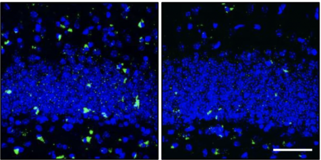 microscopy image showing cells in the dentate gyrus with tangles and fewer tangles after treatment targeting senescent cells.