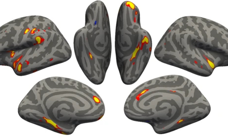 MRI scans showing regions affected by COVID infection.