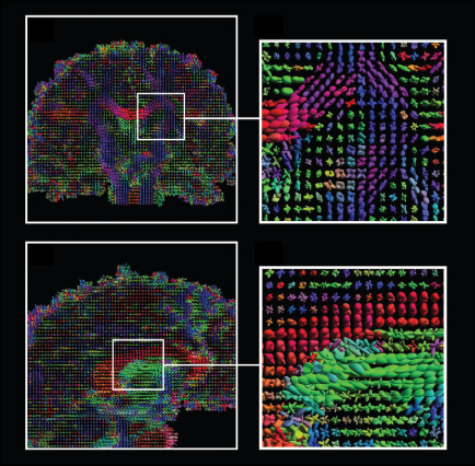 Two MRI brain scans with colorful directional arrows, each paired with a zoomed-in section showing detailed fiber pathways in different regions, highlighting brain structure and connectivity on a black background.