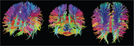 Three colorful, computer-generated images of a human brains neural pathways, shown from different angles on a black background. Each fiber bundle is depicted in various bright colors representing direction.