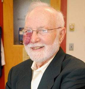 An older man with white hair and beard, wearing glasses, a suit jacket, and a light shirt. He has a large red birthmark covering his right eye and is smiling while standing indoors.