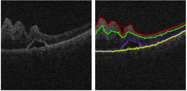 Side-by-side OCT eye scans: left image shows grayscale layers, right image highlights layers with red, green, blue, and yellow lines tracing their contours.