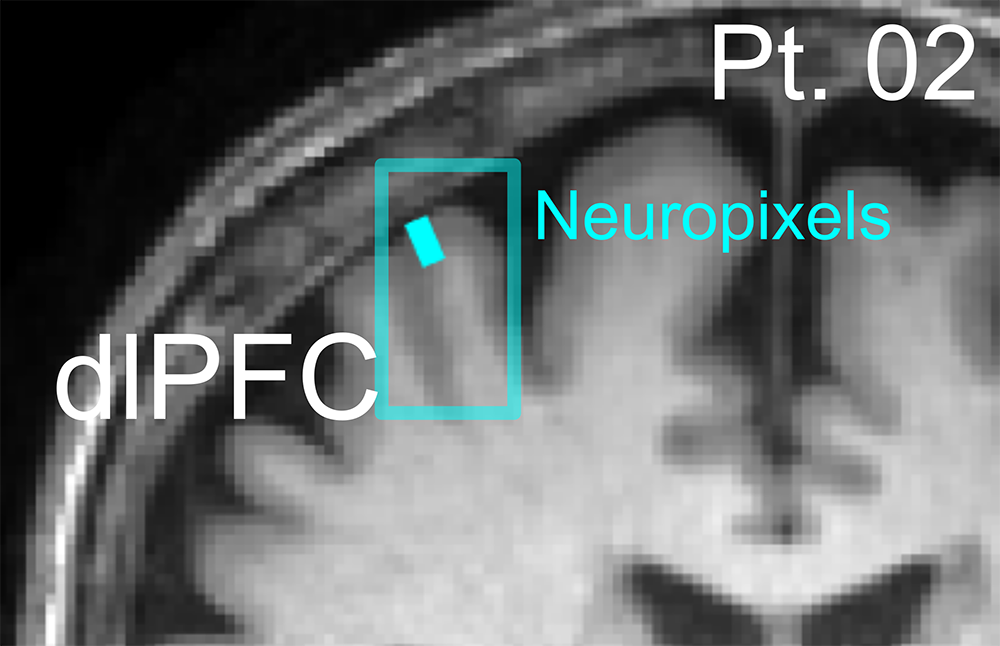 A photograph of the intended location for the Neuropixels array temporarily implanted during a DBS procedure.