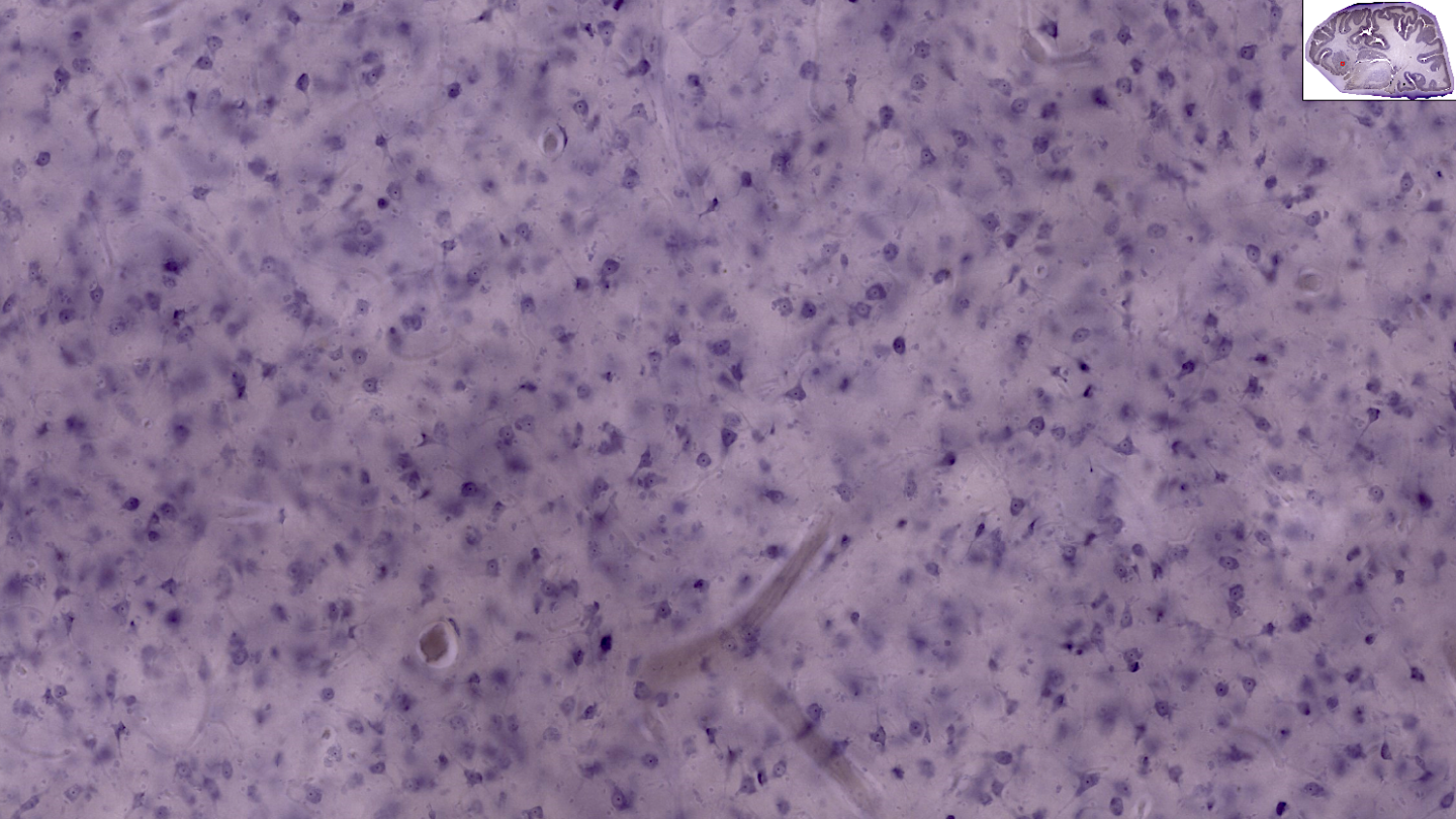 Microscopic view of brain tissue stained purple, showing numerous small, dark nuclei scattered throughout a lighter background. An inset at the top right displays a section of the brain.
