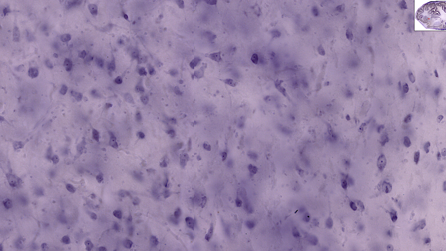 Microscopic view of brain tissue stained light purple, showing various scattered, dark-stained cell nuclei and a small inset of a brain diagram in the upper right corner.