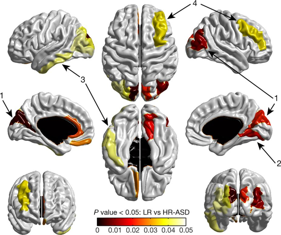 Figure of Surge in brain surface area precedes autism diagnosis