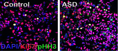 Two microscopy images labeled Control and ASD show cells stained with DAPI (blue), Ki67 (red), and pHH3 (green). Cell staining patterns differ between control and ASD samples.