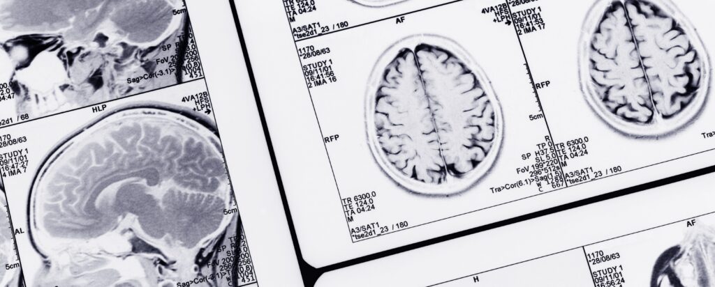 Close-up of several MRI brain scans showing cross-sectional images of the brain in both sagittal and axial views, arranged on a light background.