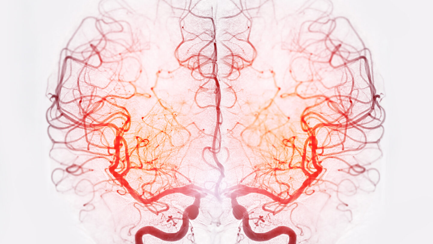 Colored angiogram of normal brain blood vessels.