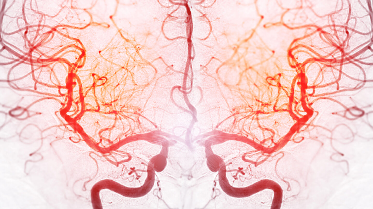 Colored angiogram of normal brain blood vessels.