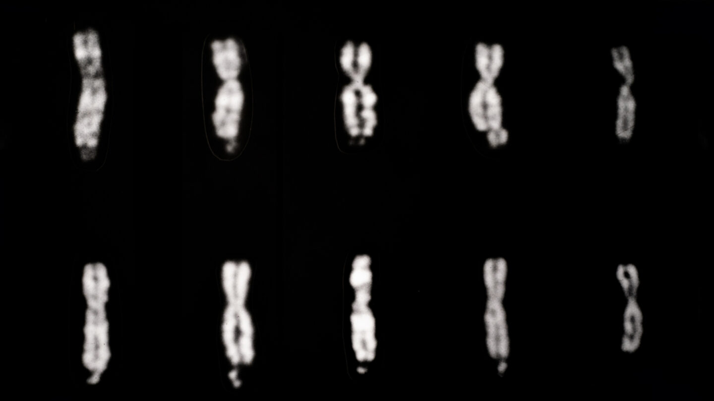 Black-and-white micrograph showing ten human X chromosomes arranged in two rows against a dark background. Several chromosomes display the characteristic fragile-X appearance, with a narrowed or constricted region near the tip of the long arm that gives them a stretched or partially separated shape. Normal X chromosomes, shown on the right side for comparison, appear more uniformly condensed and lack the fragile-site constriction. The image illustrates Q-banded chromosome staining used to identify fragile X chromosome abnormalities.